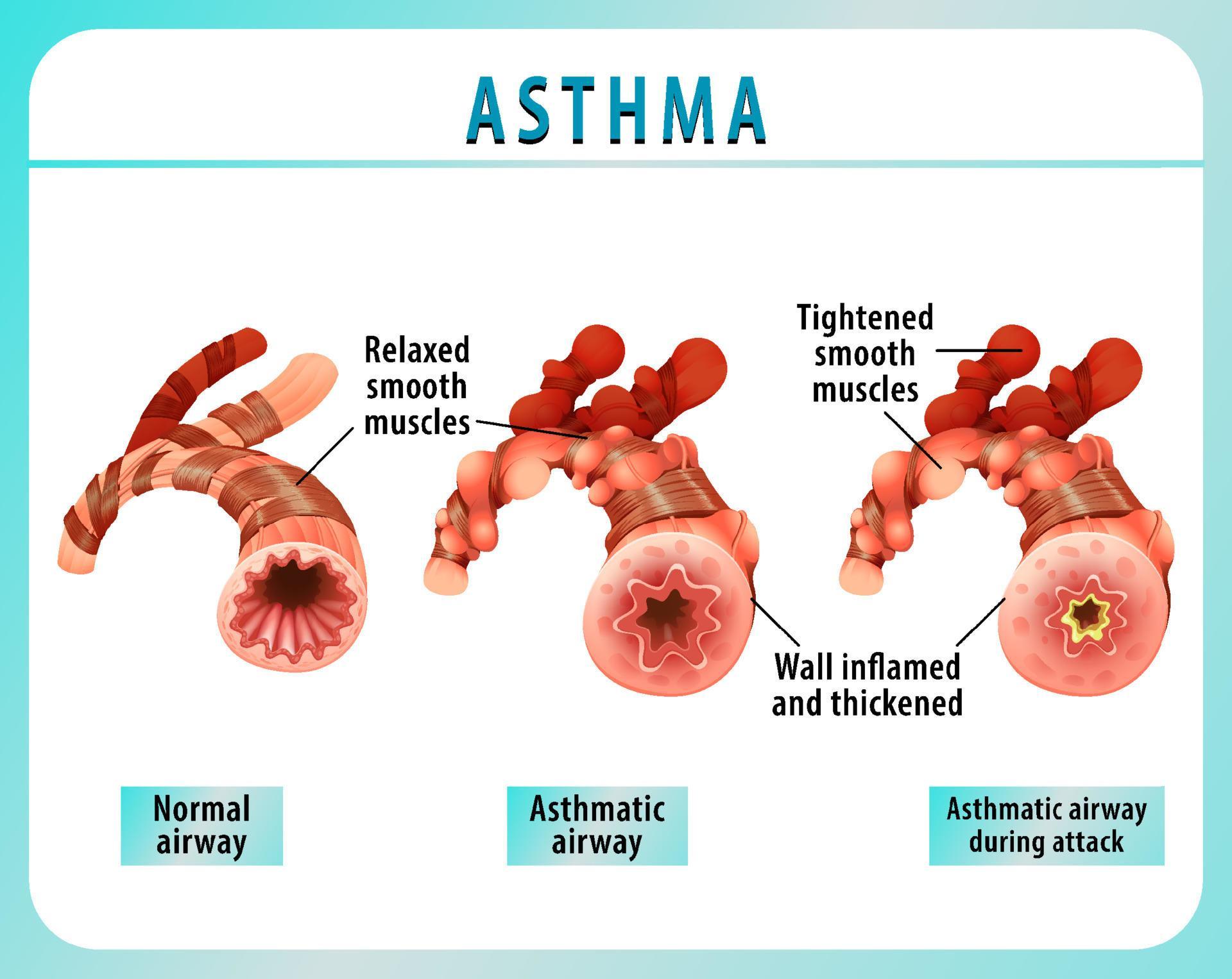 Bronchial Asthma diagram with normal airway and asthmatic airway
