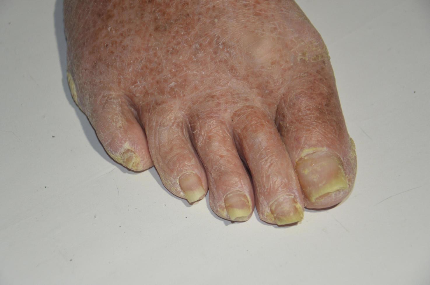 Old and sore feet of men and women on a white background photo