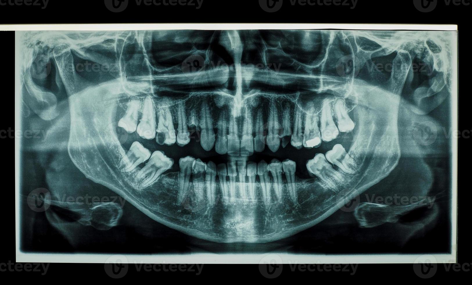 teeth panoramic xray photo