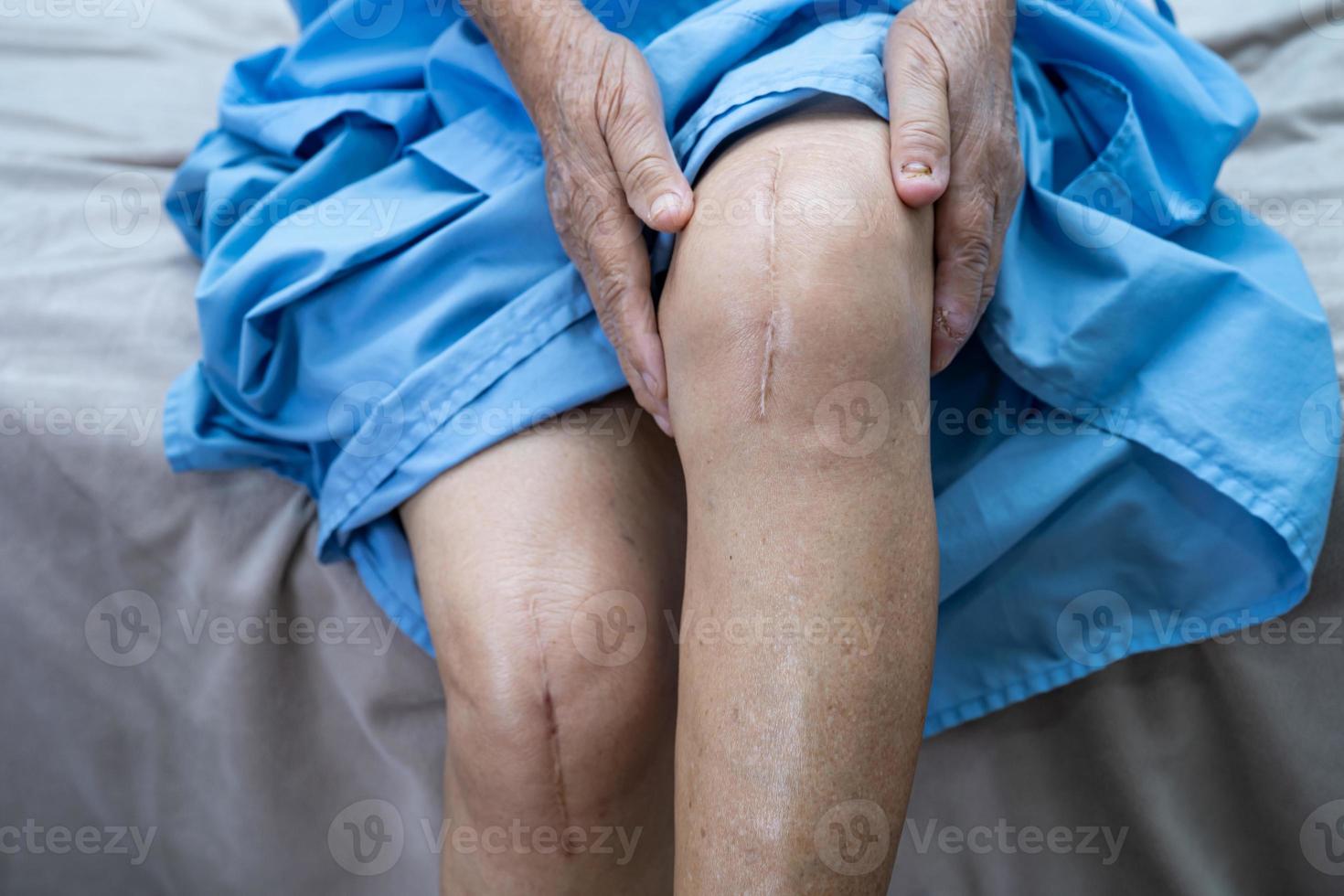 Asian senior or elderly old lady woman patient show her scars surgical total knee joint replacement Suture wound surgery arthroplasty on bed in nursing hospital ward, healthy strong medical concept. photo