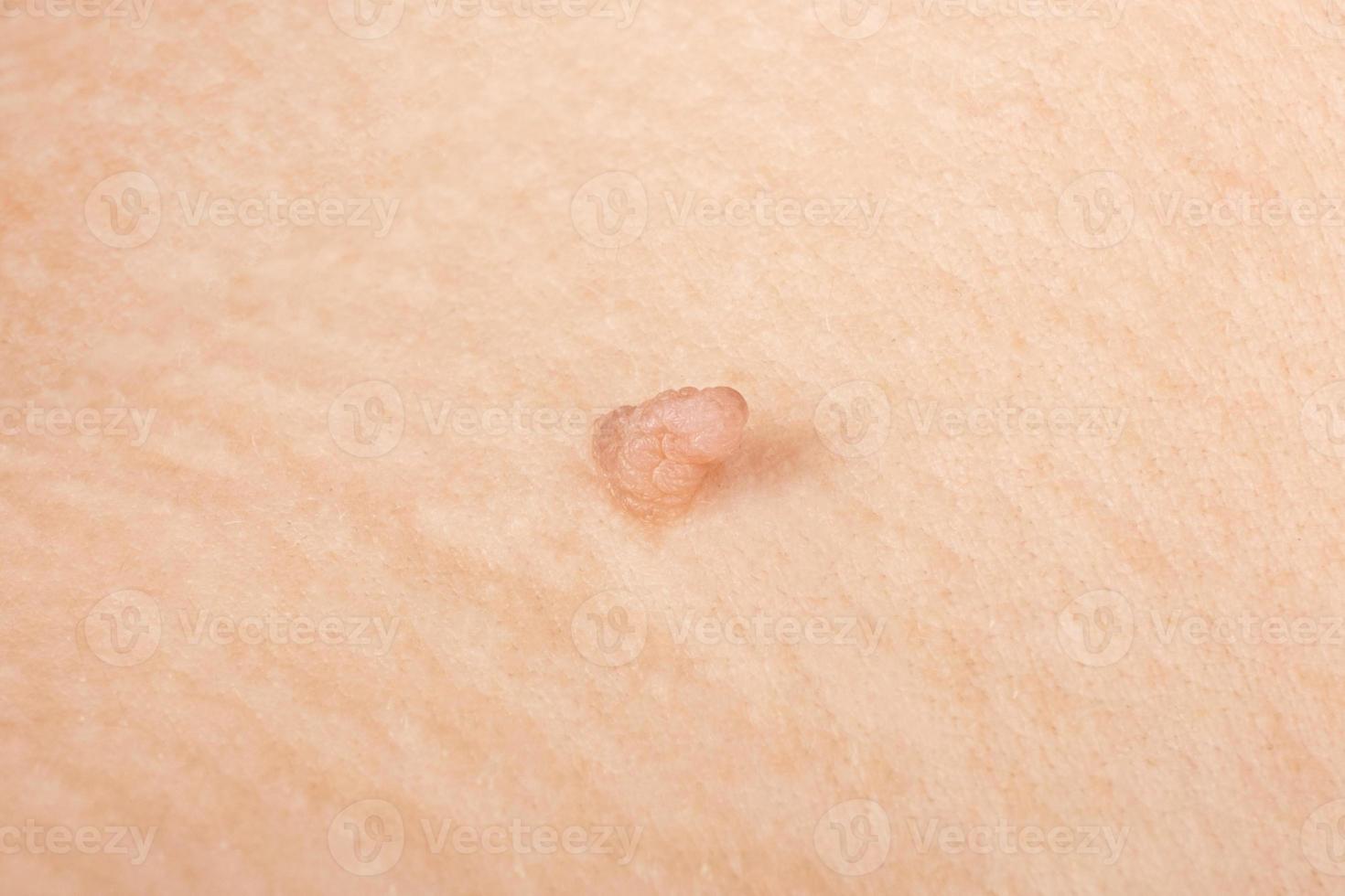 papilloma close up, big birthmark on the skin photo