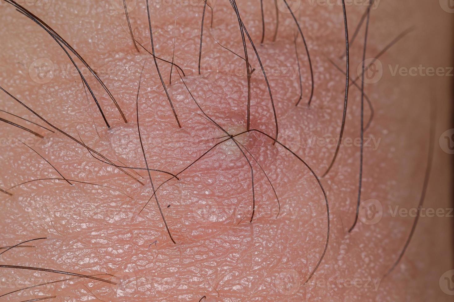 inflammation-caused-by-ingrown-hair-3752292-stock-photo-at-vecteezy