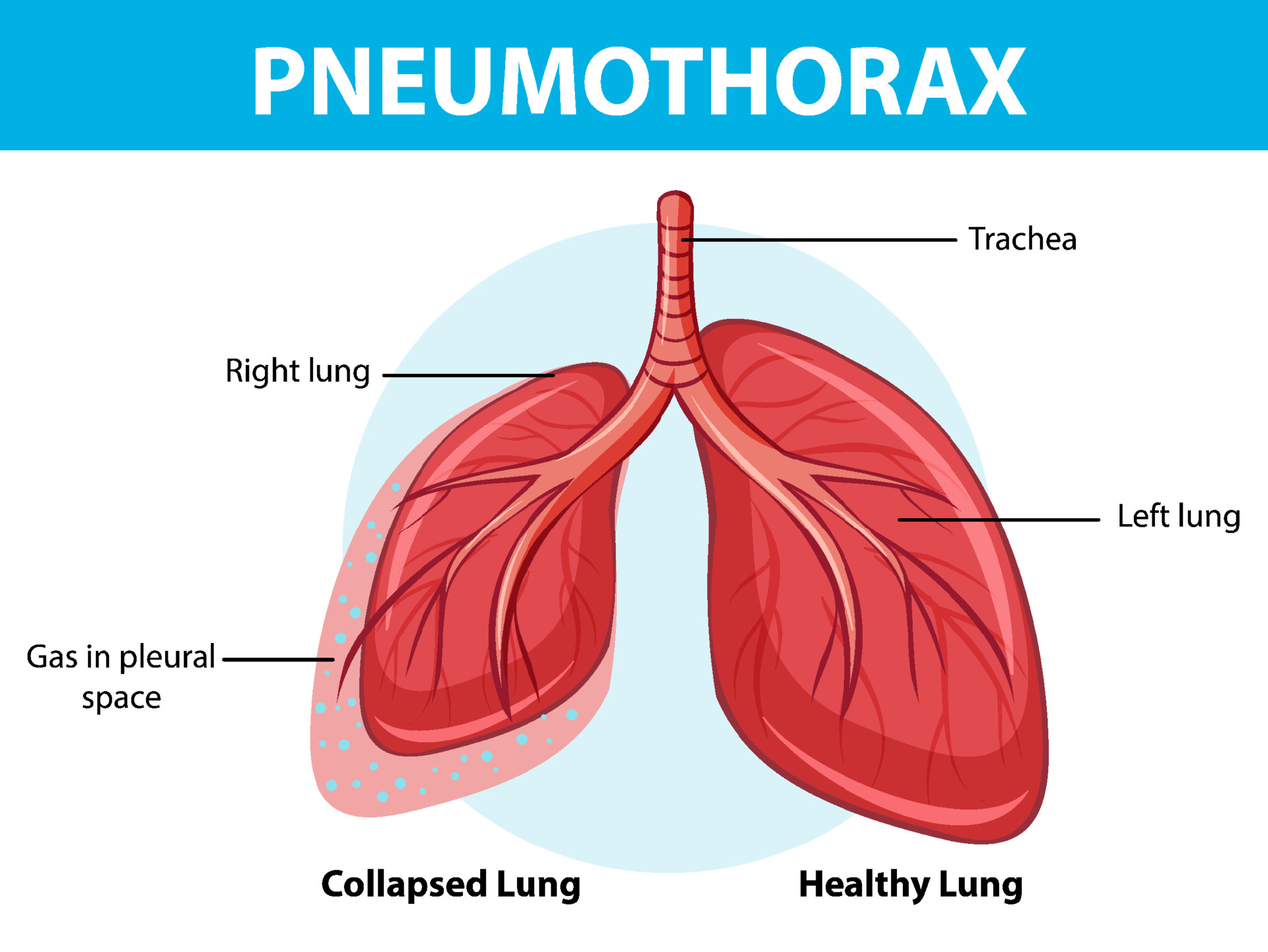 Pneumothorax diagram with collapsed lung and healthy lung 3763970