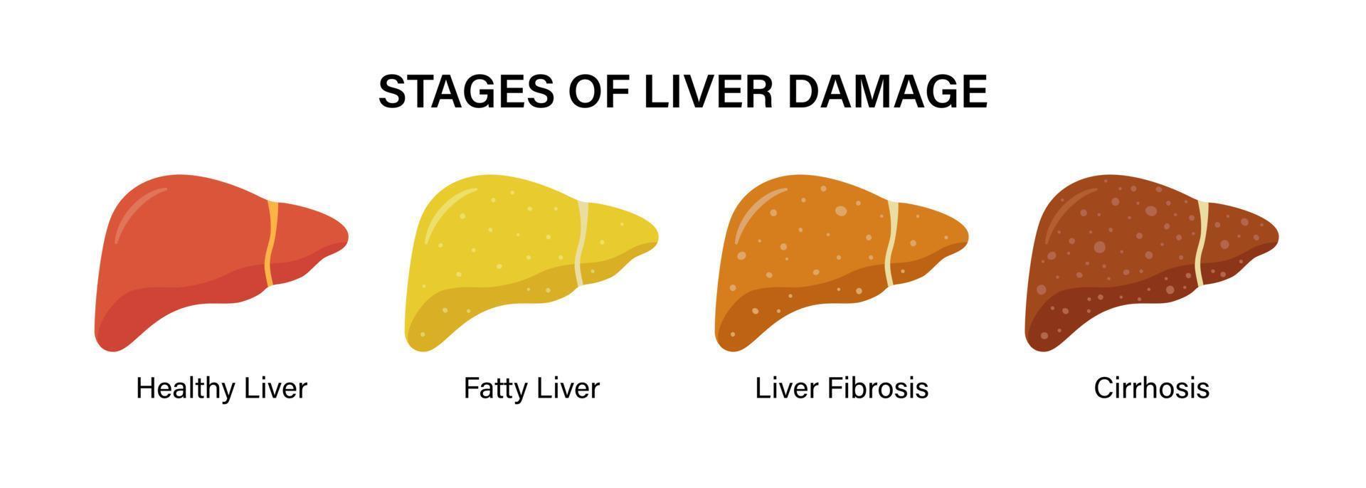 Stages of nonalcoholic liver damage. Healthy, fatty and cirrhosis