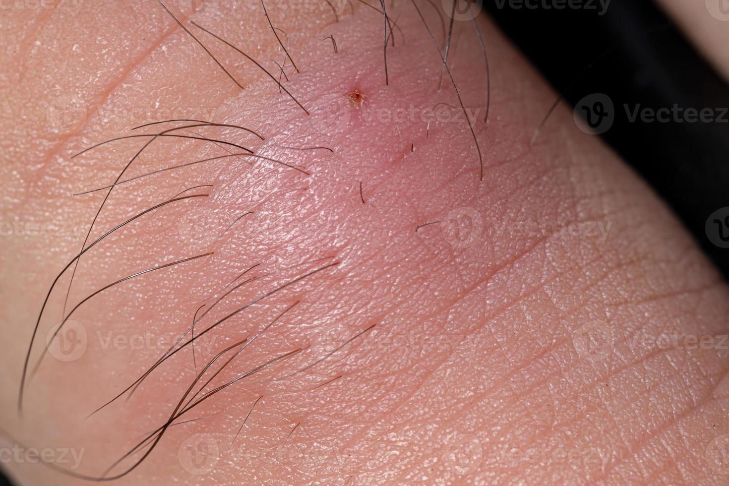 Inflammation caused by ingrown hair photo