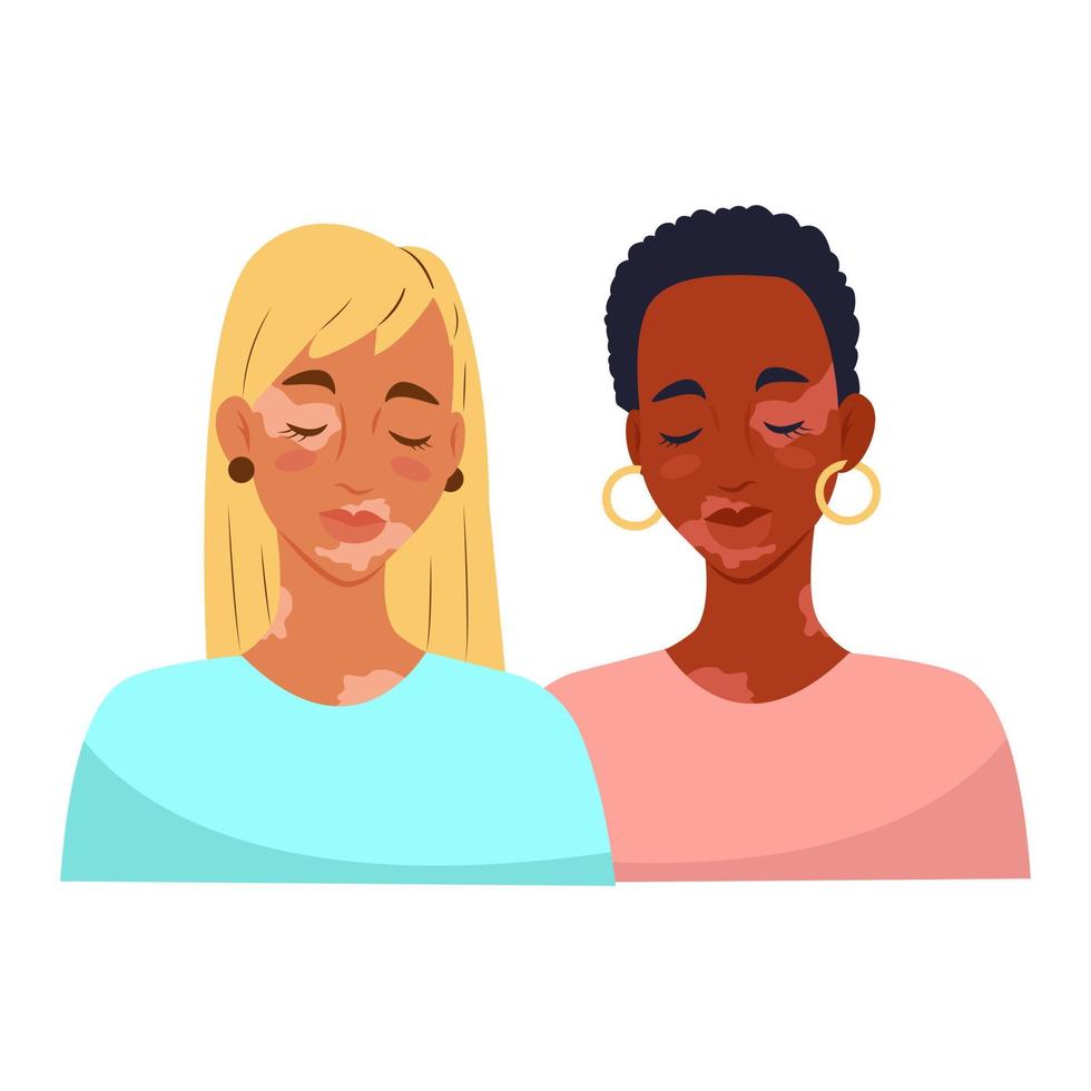 Two women with vitiligo. Vitiligo skin disease. Vector illustration