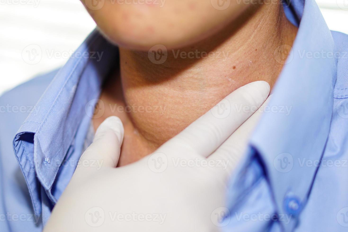 Asian lady woman patient have abnormal enlargement of thyroid gland Hyperthyroidism overactive thyroid at the throat, healthy strong medical photo