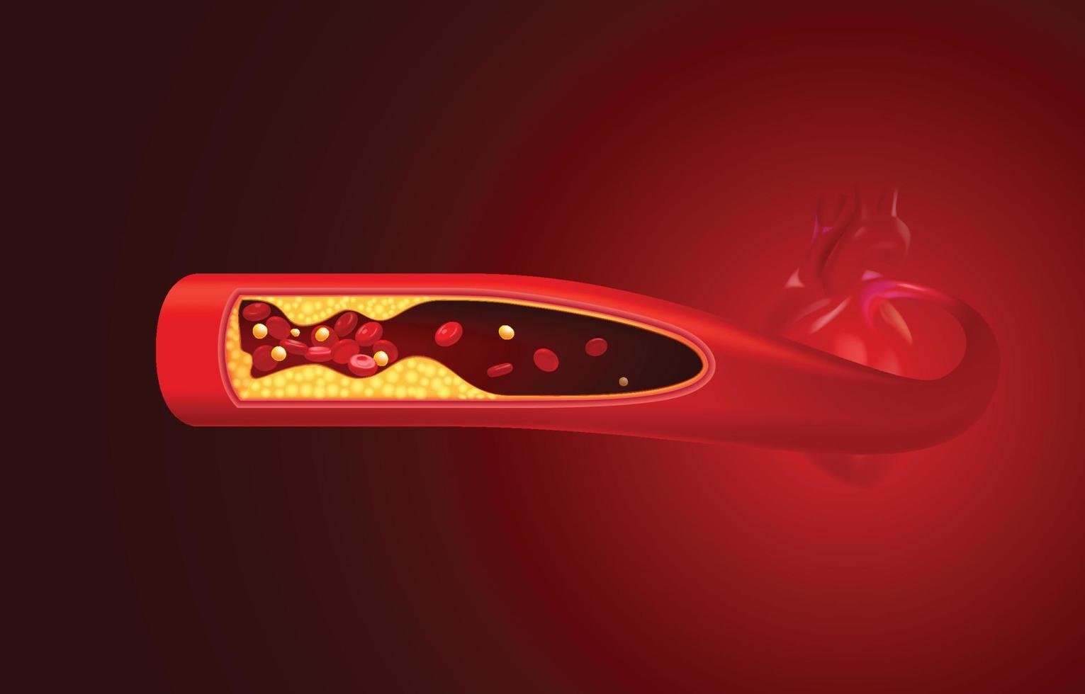 Red blood cells and cholesterol clog before the heart. vector