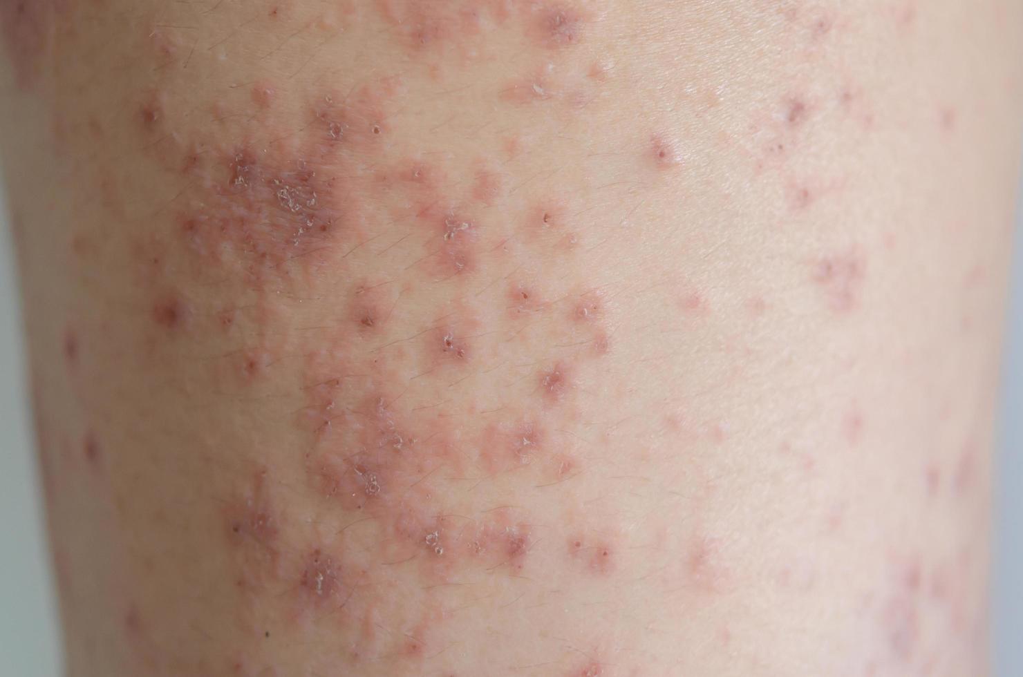 Close-up of skin rashes caused by allergies. photo