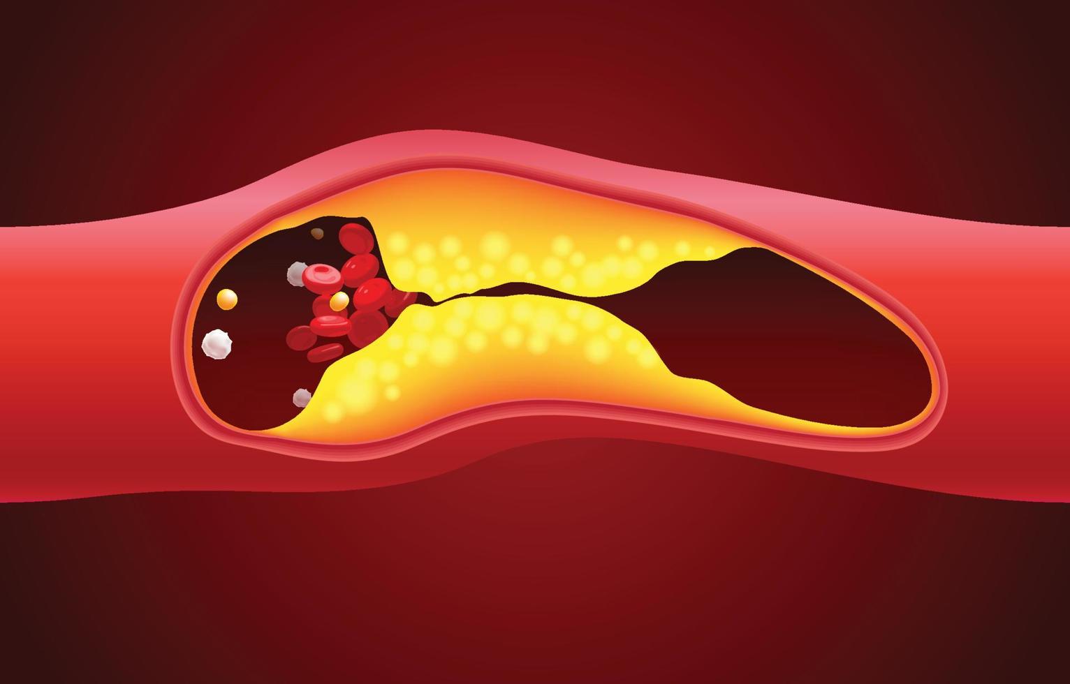 Red blood cell and cholesterol blockage illustration vector