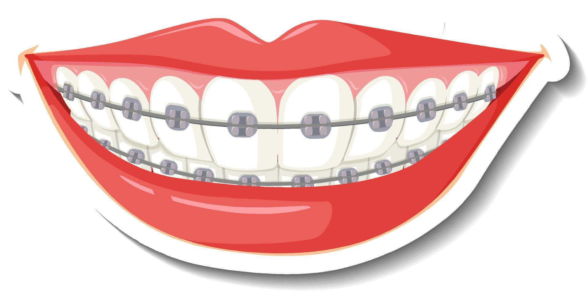 dientes con frenillos sobre fondo blanco vector