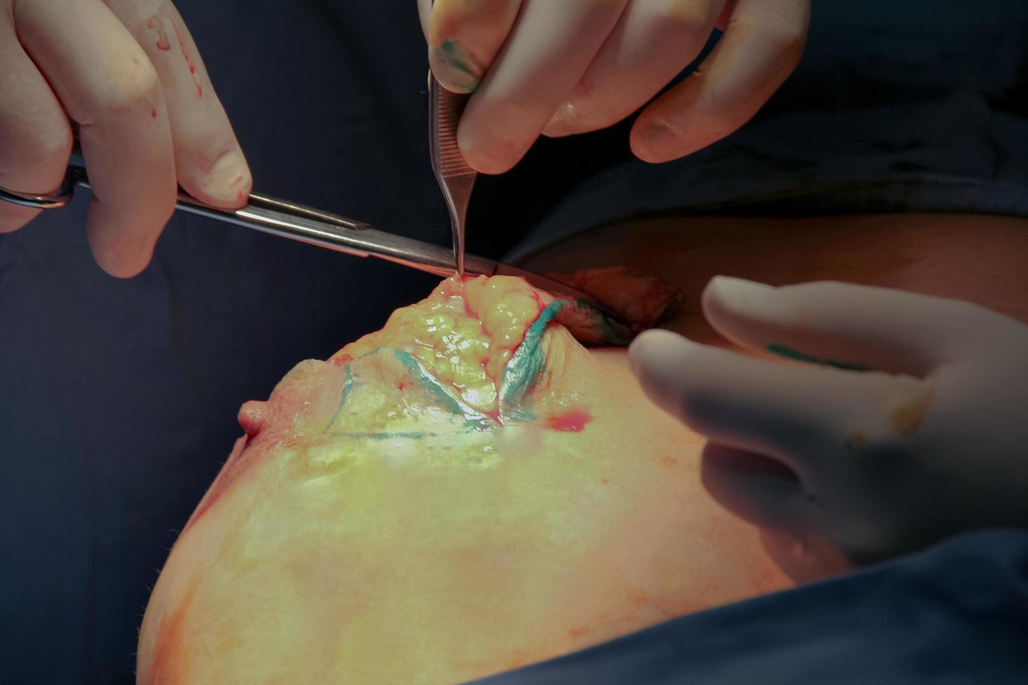 Close-up of breast augmentation surgery in the operating room. photo