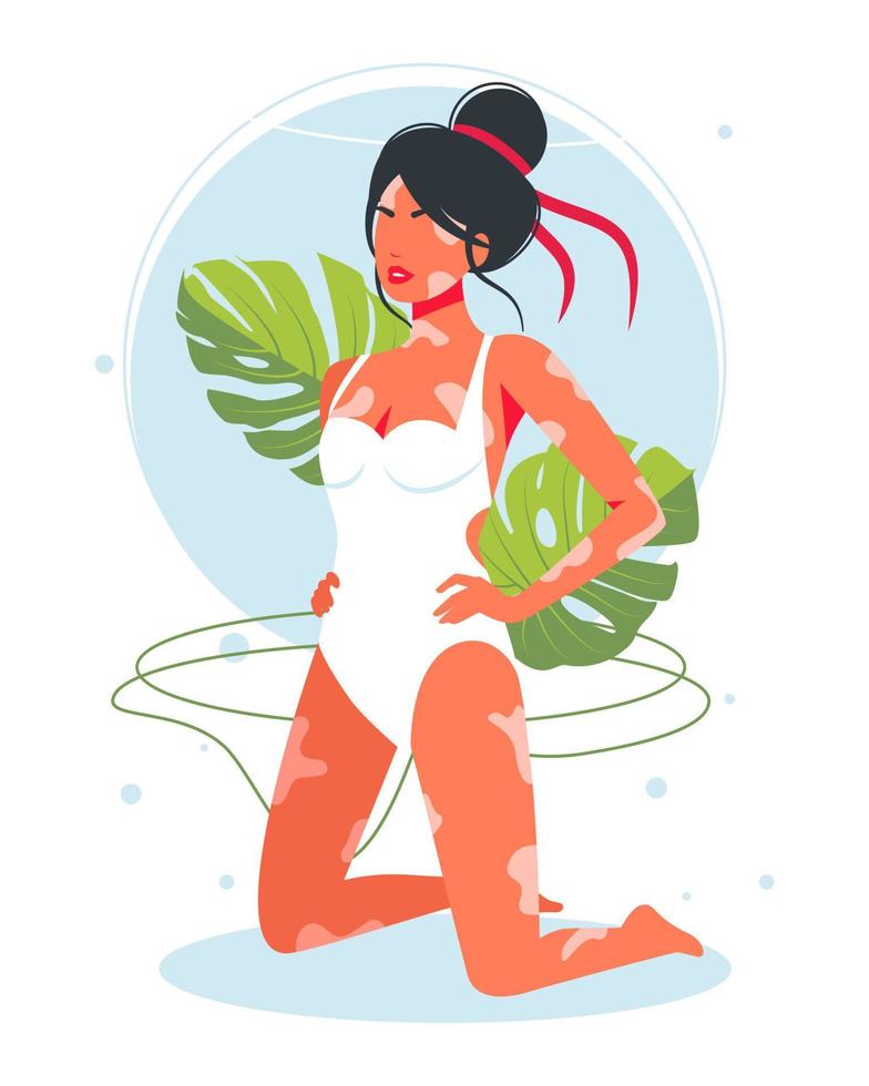 Vitiligo skin disease in girl in a swimsuit. woman with a diagnosis of vitiligo sunbathing on the beach is not shy. the concept of different beauty, bodily positive, self-acceptance. vector