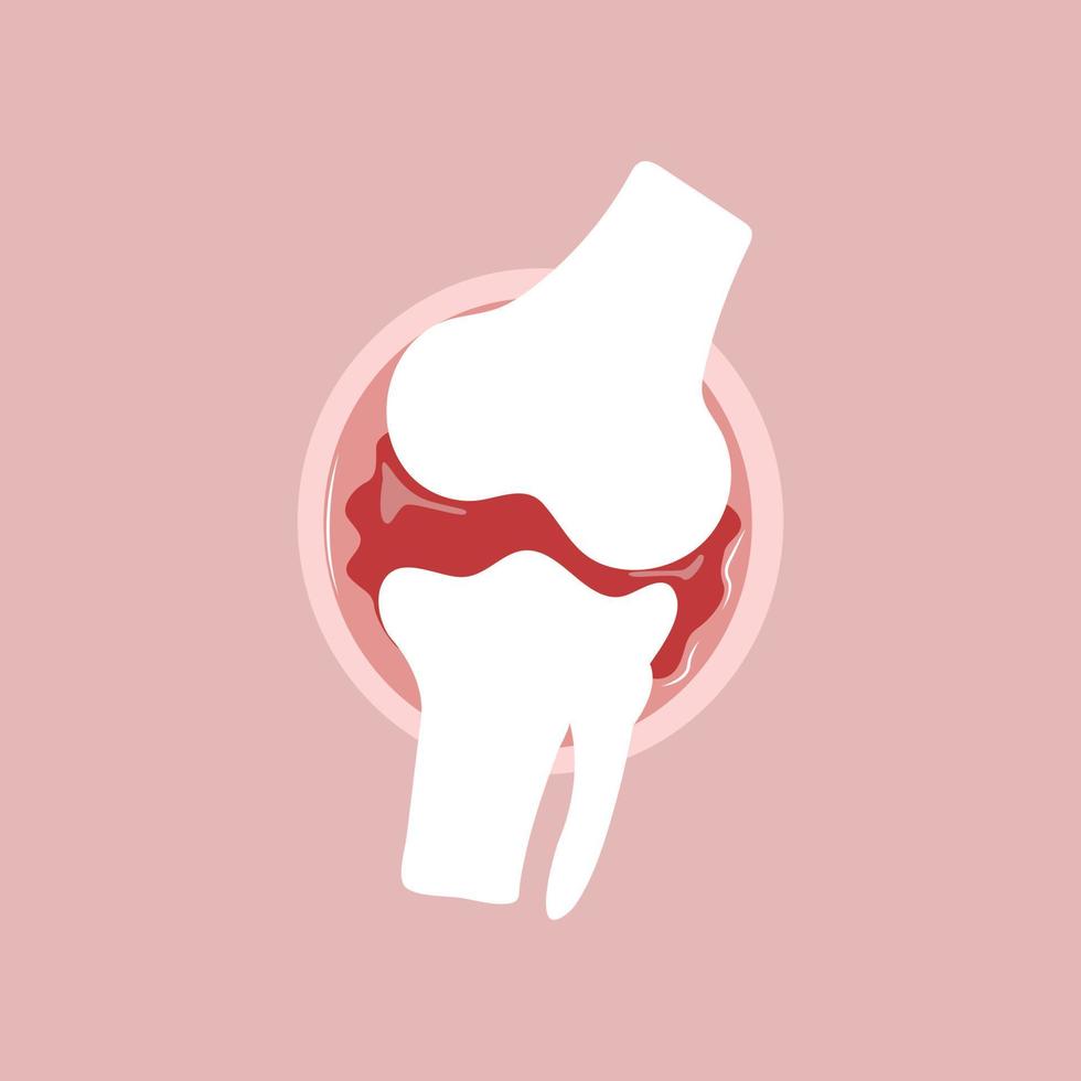 Illustrative flat vector of arthritis