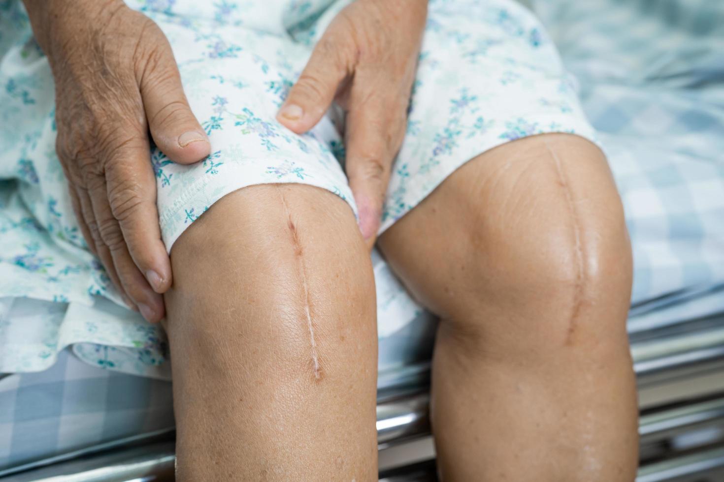 Asian senior or elderly old lady woman patient show her scars surgical total knee joint replacement Suture wound surgery arthroplasty on bed in nursing hospital ward, healthy strong medical concept. photo