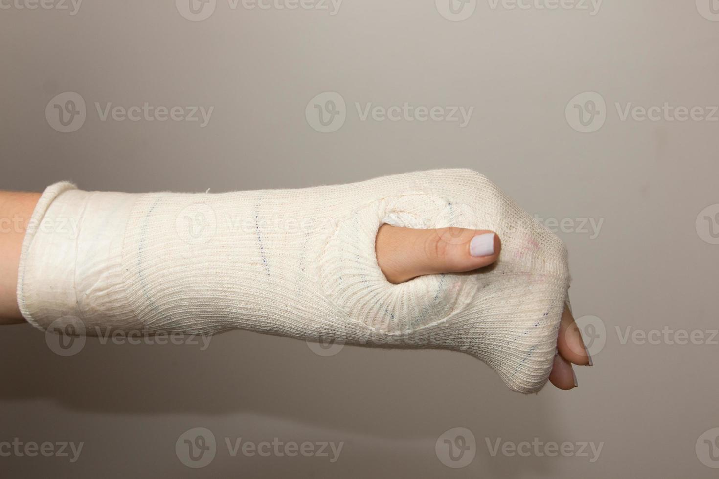 Lady with a Broken Hand and Wrist wrapped in a cast photo