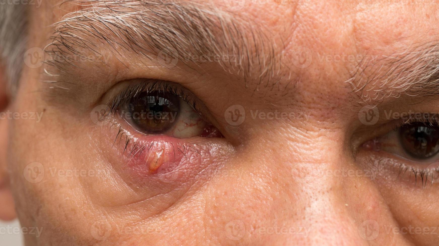 hombre con un enorme orzuelo en el párpado foto