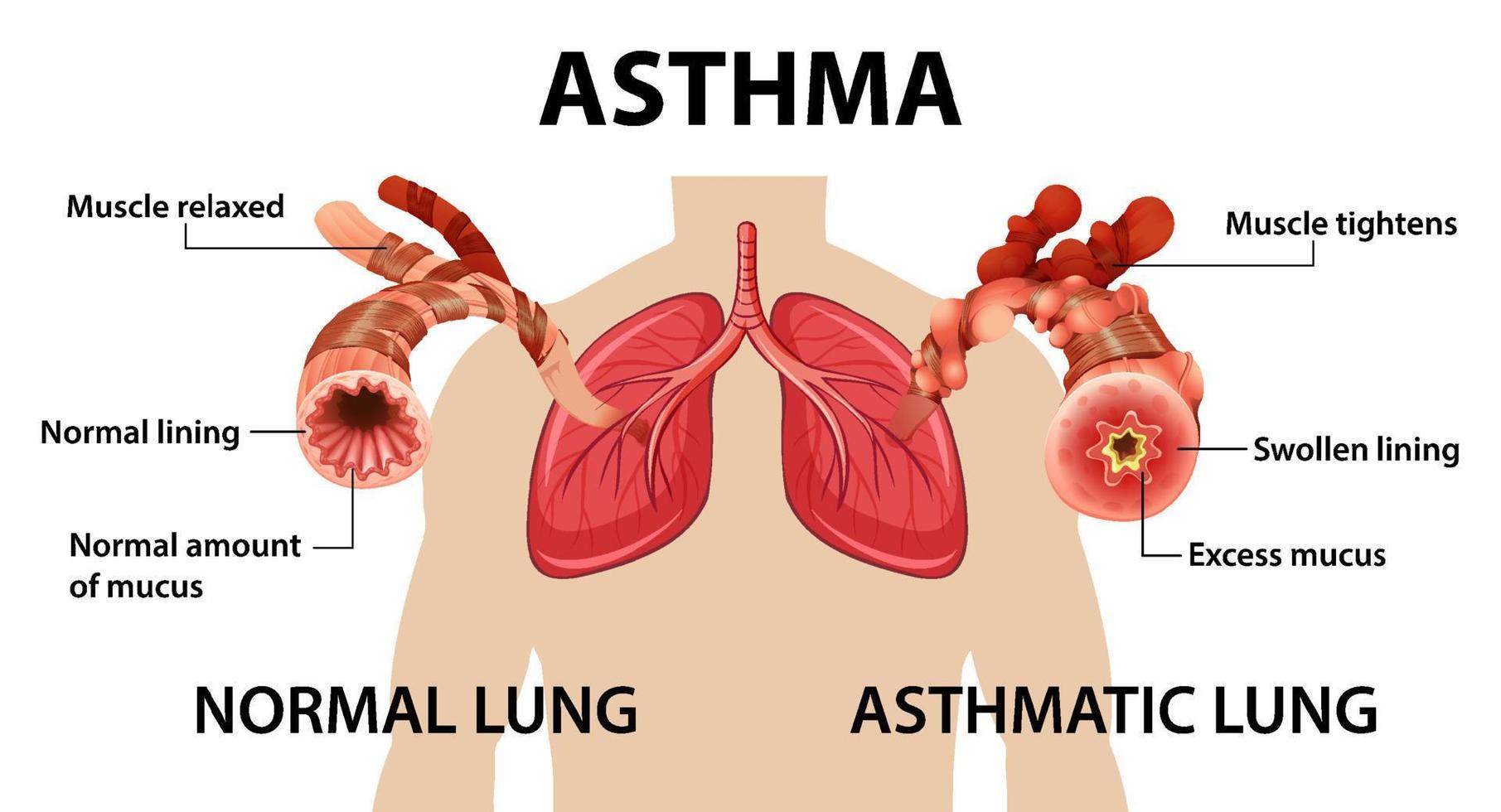 Bronchial Asthma diagram with normal lung and asthmatic lung vector