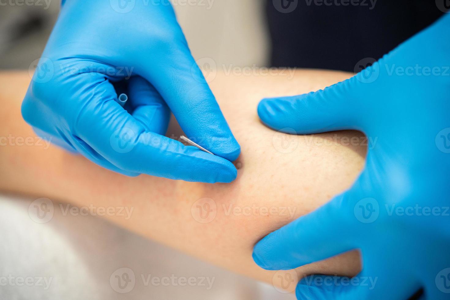 Hands of physiotherapist doing a dry needling photo