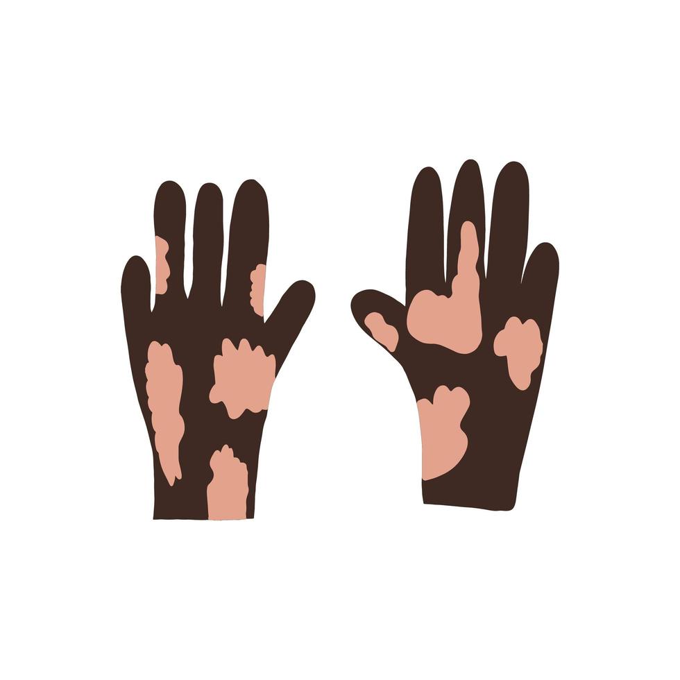 Flat vector cartoon illustration of hands with vitiligo. World vitiligo day. Skin diseases, pigmentation disorders.