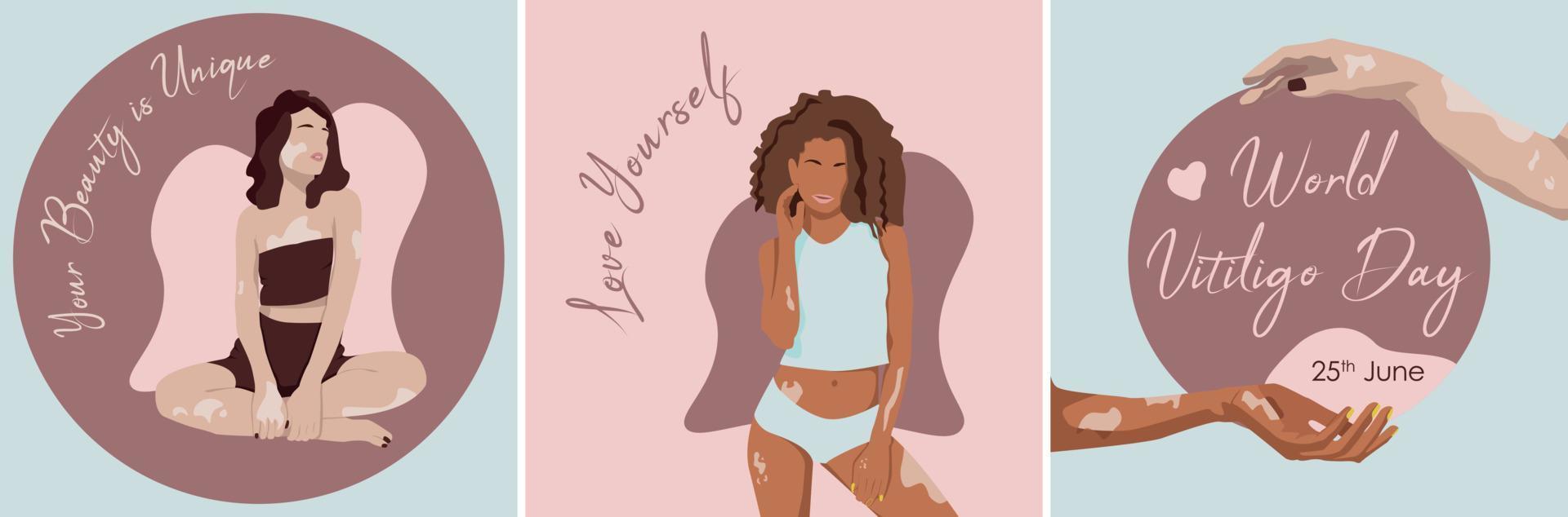 World Vitiligo Day 25th June. Two hands with Vitiligo desease around world. vector