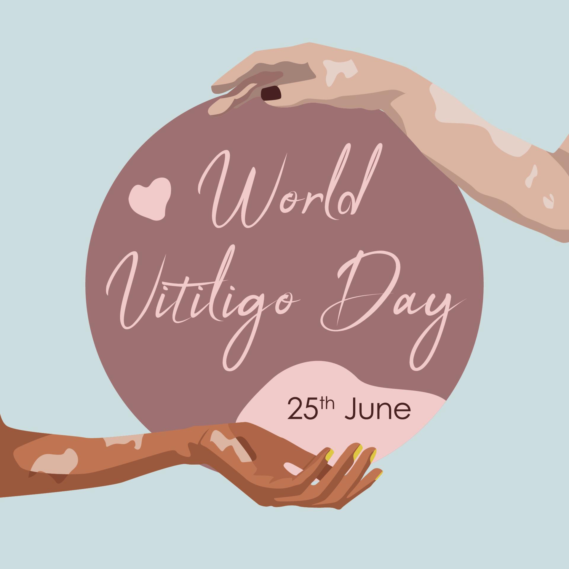 World Vitiligo Day 25th June. Two hands with Vitiligo desease around