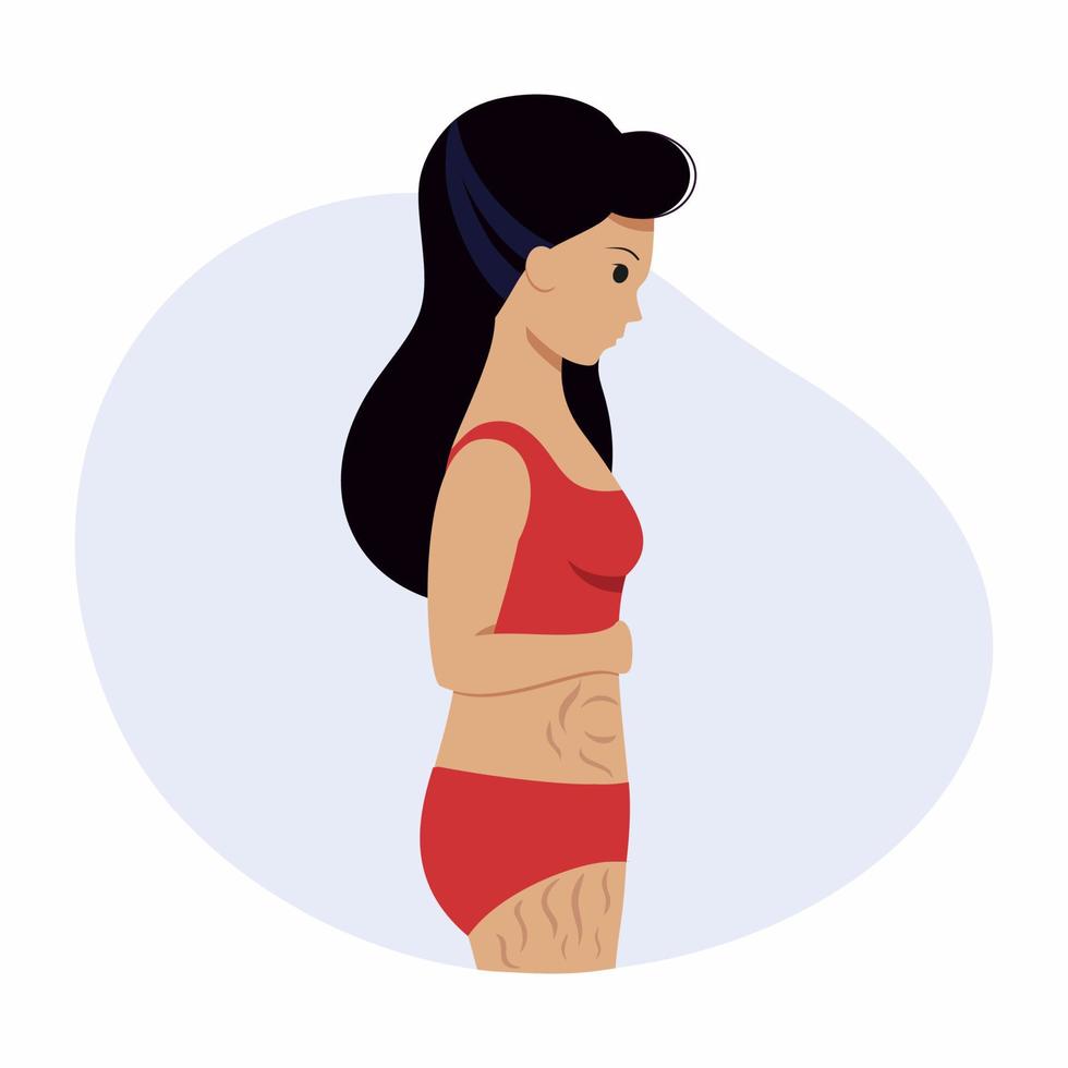 A young woman with striae on her stomach and thighs. Defects and problems with the skin. Vector illustration in a flat style.