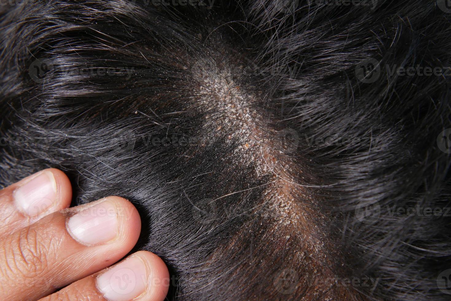 men with dandruff in his hair, closeup photo