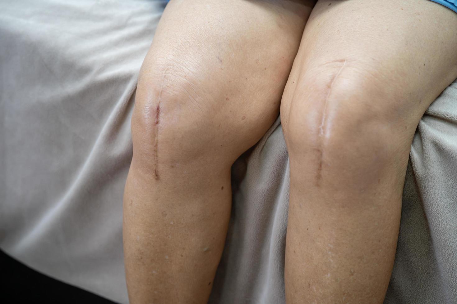 Asian senior or elderly old lady woman patient show her scars surgical total knee joint replacement Suture wound surgery arthroplasty on bed in nursing hospital ward, healthy strong medical concept. photo