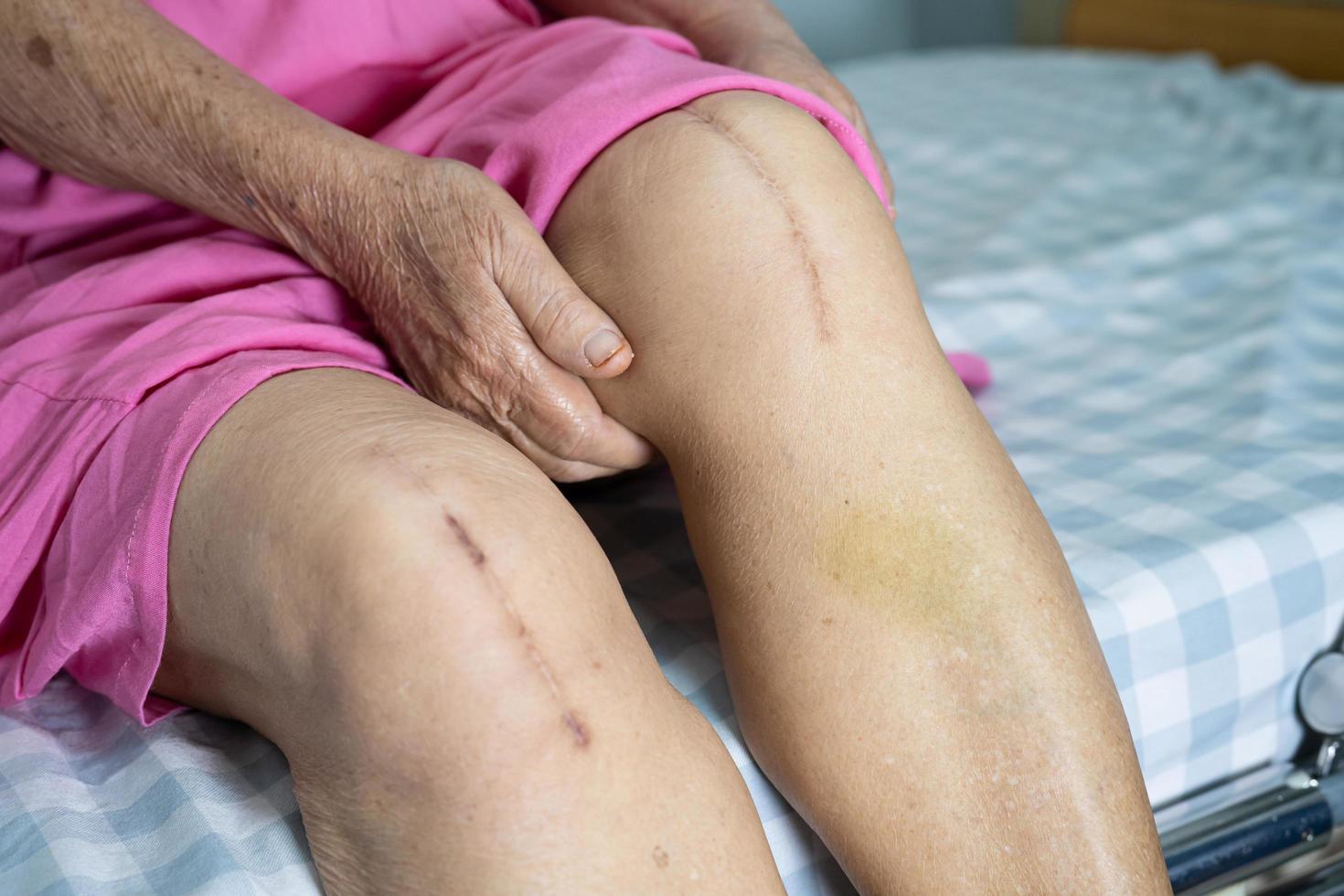paciente asiático mayor o anciana mujer muestra sus cicatrices quirúrgico reemplazo total de la articulación de la rodilla sutura herida cirugía artroplastia en la cama en la sala del hospital de enfermería, concepto médico fuerte y saludable. foto
