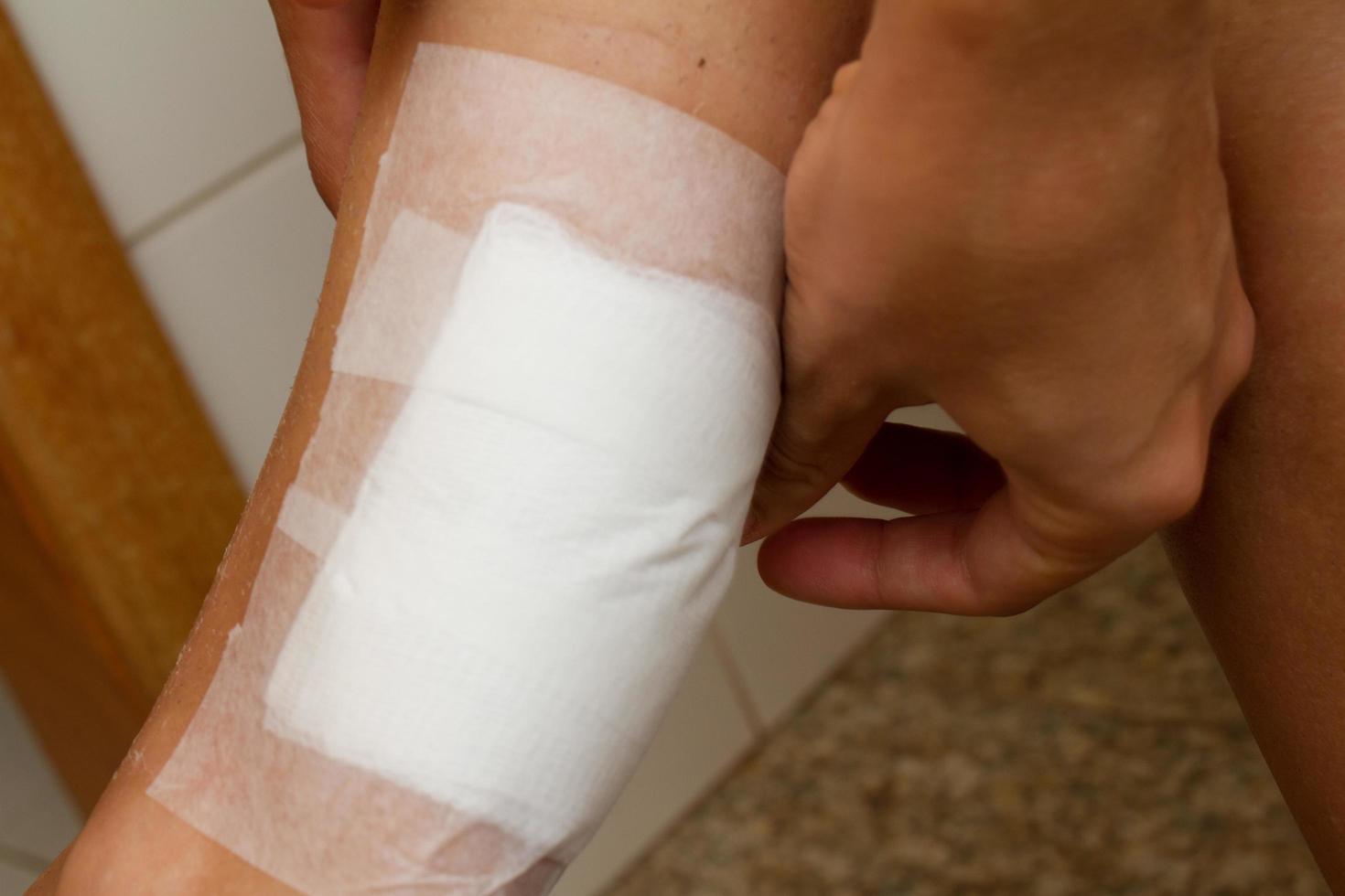 A woman applying a gauze bandage to a second degree burn on the back of her leg photo