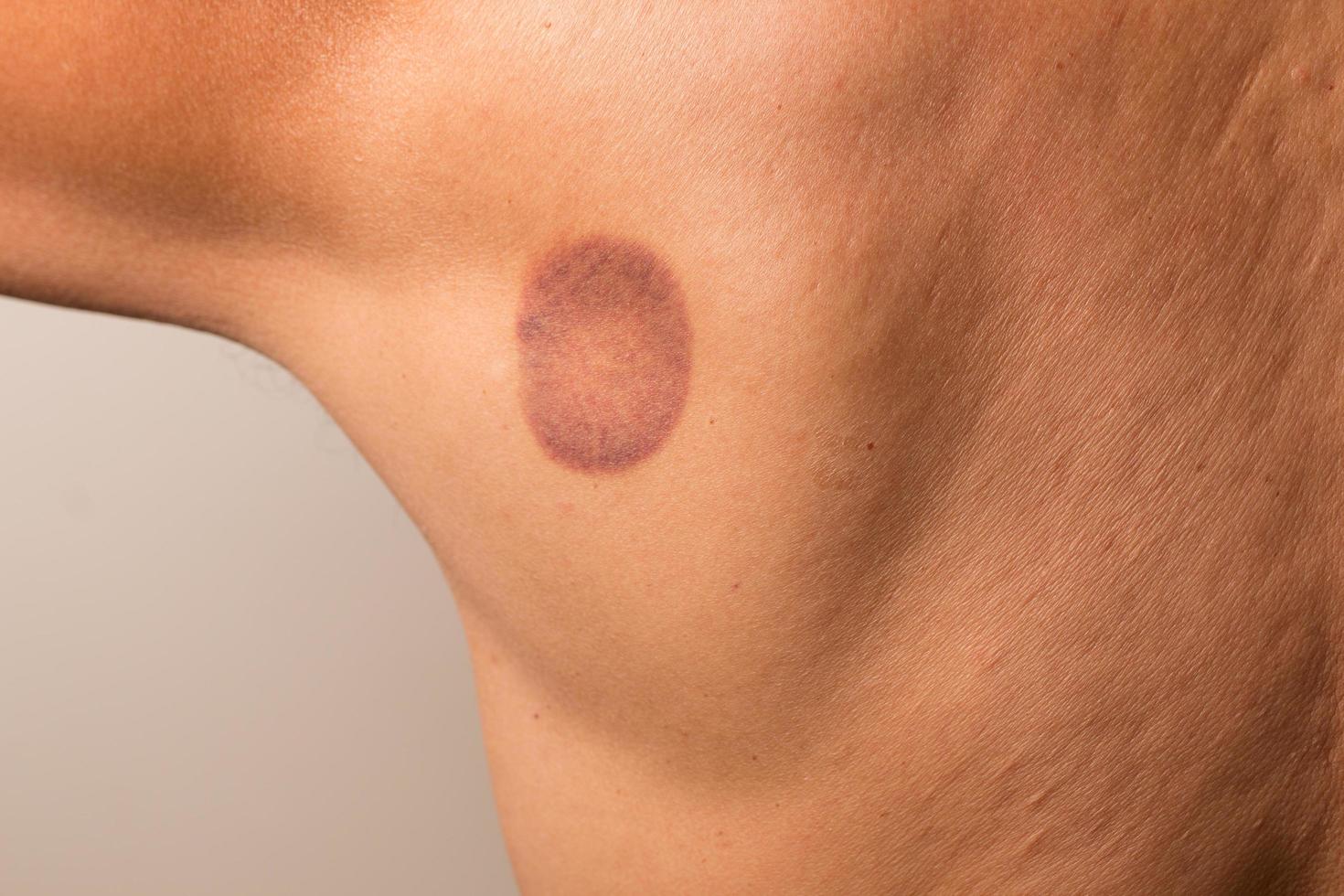Patient that had cupping therapy done on his upper back for pain management photo