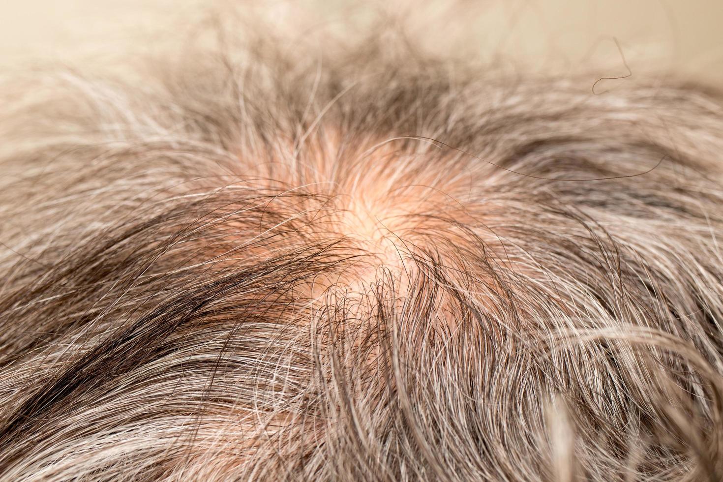 Older man with thinning hair on the back of his head around the crown photo