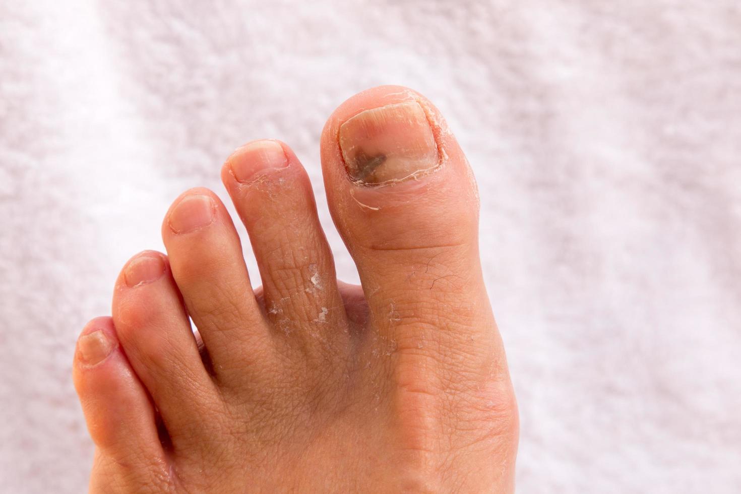 Close up of a Persons Broken Big Toe photo