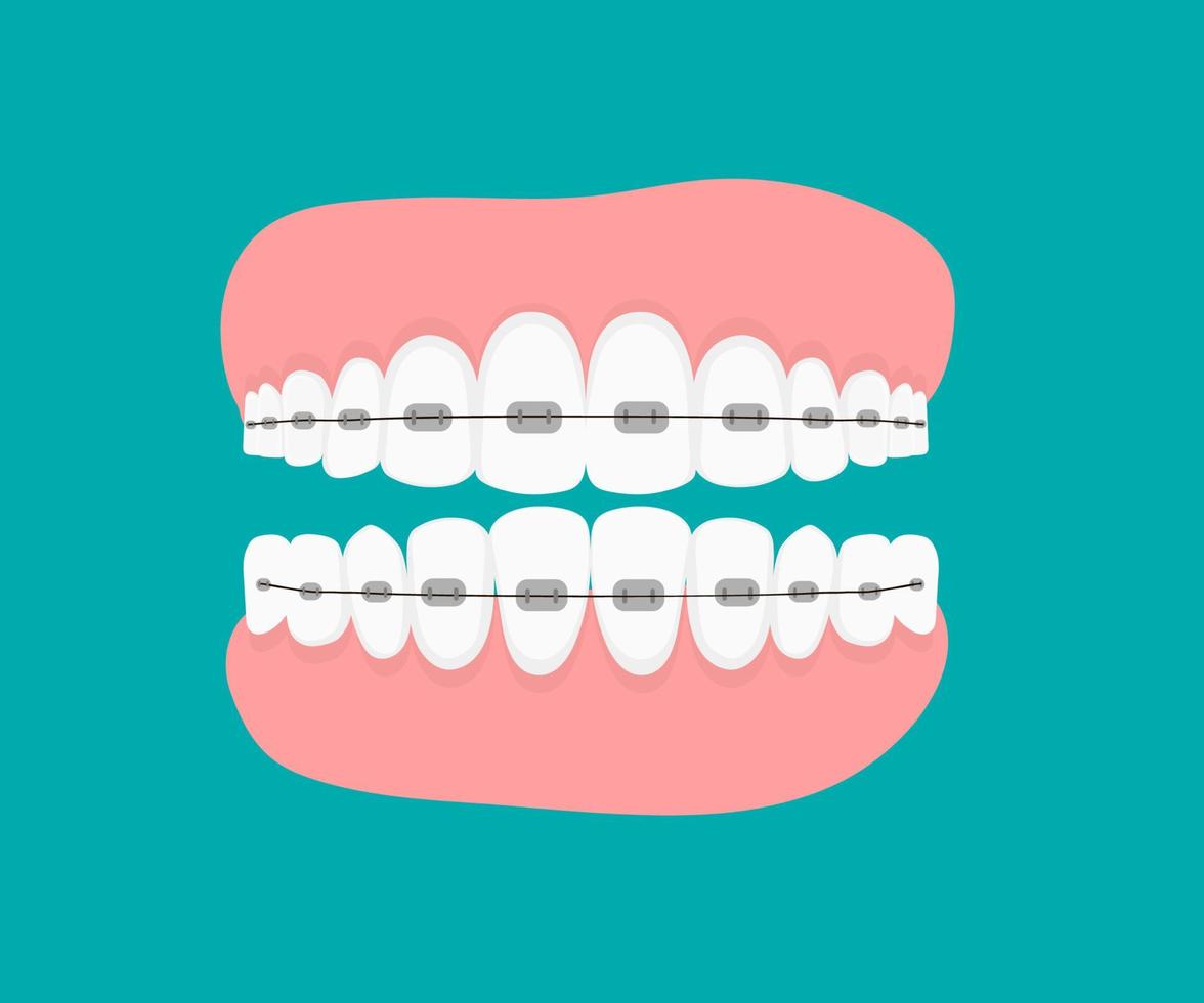 dientes con braces.flat ilustración vectorial. mandíbulas aisladas. ortodoncia tratamiento ortodoncia en los dientes. tratamiento de odontología y ortodoncia. fila dental con tirantes vector