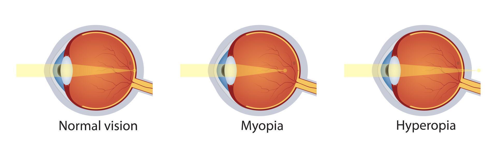 visión normal, hipermetropía, miopía. conjunto de trastornos de la visión. anatomía del defecto del globo ocular. ilustración vectorial vector