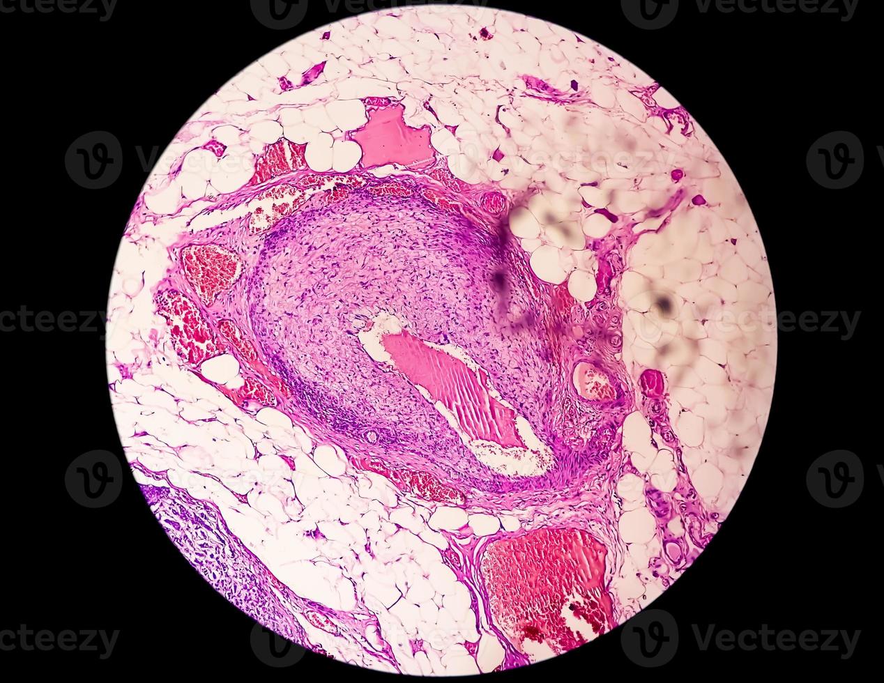 Breast Cancer Awareness - Microscopic image of core biopsy for infiltrating ductal carcinoma, detected by screening mammogram. Invasive ductal carcinoma, Grade-II photo