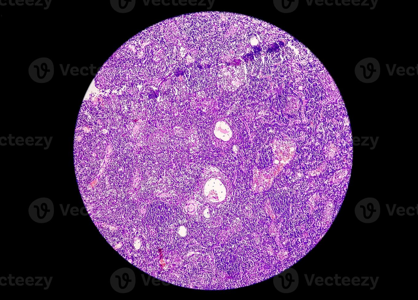 Low power photomicrograph of a breast core biopsy showing an invasive ductal carcinoma grade-II,  most common form of breast cancer. Lymphovascular invasion - Present photo