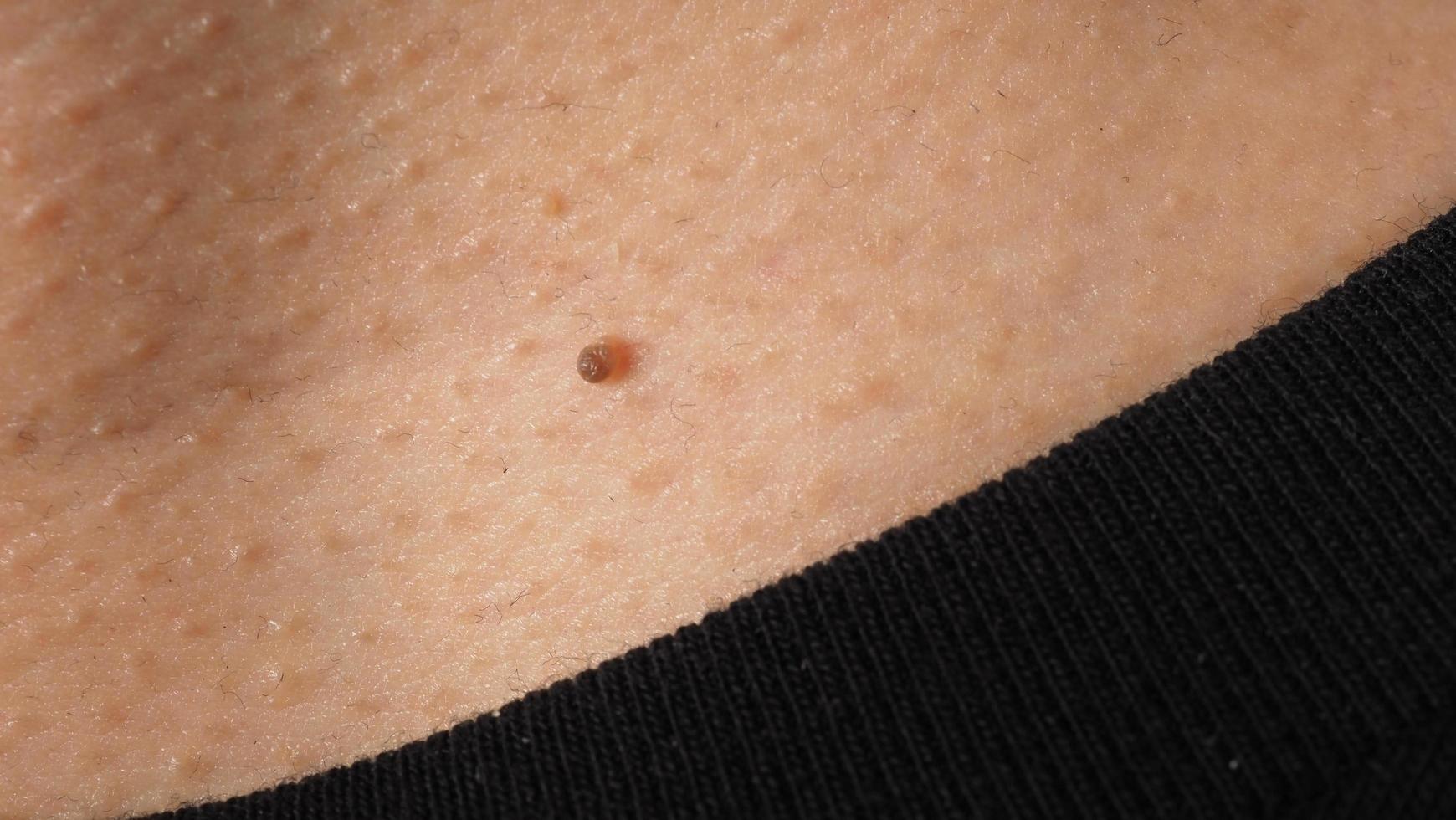Wart on face. Macro shot of wart near eye. Papilloma on skin. photo
