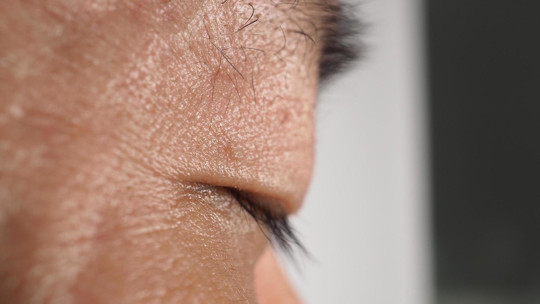 Wart on face. Macro shot of wart near eye. Papilloma on skin. photo