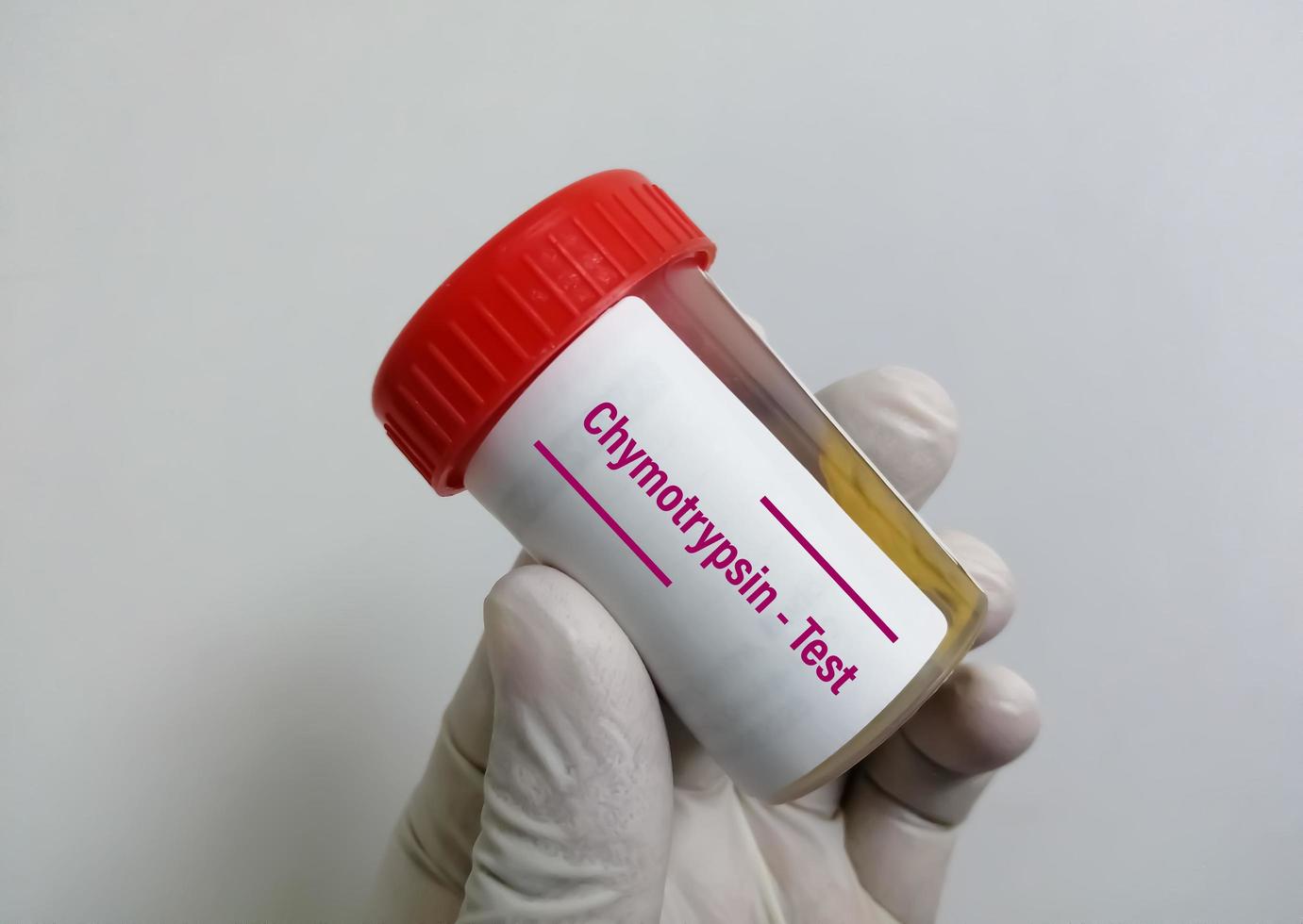 Researcher hold sample in container for Stool Chymotrypsin test with white background. Fecal Chymotrypsin test, pancreatic insufficiency. Pancreatitis. Cystic fibrosis photo