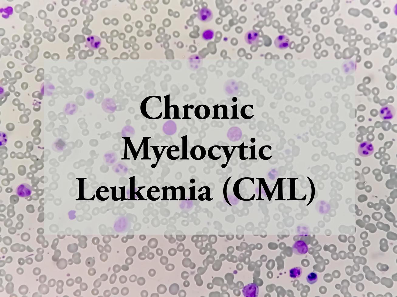 Chronic myelocytic leukemia term. Health and medical concept. CML photo