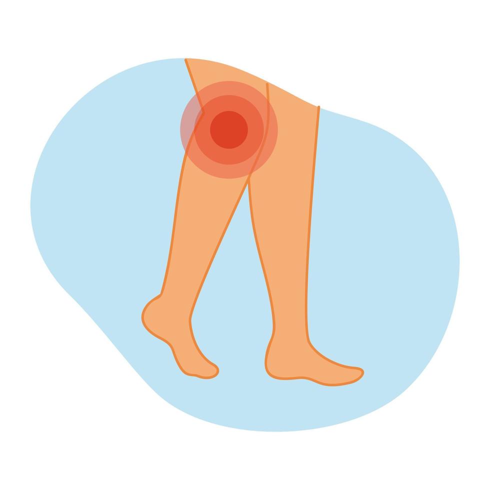 Arthritis of the knee joint. Vector illustration of legs with inflammation in the knee area. Diseases of the musculoskeletal system.