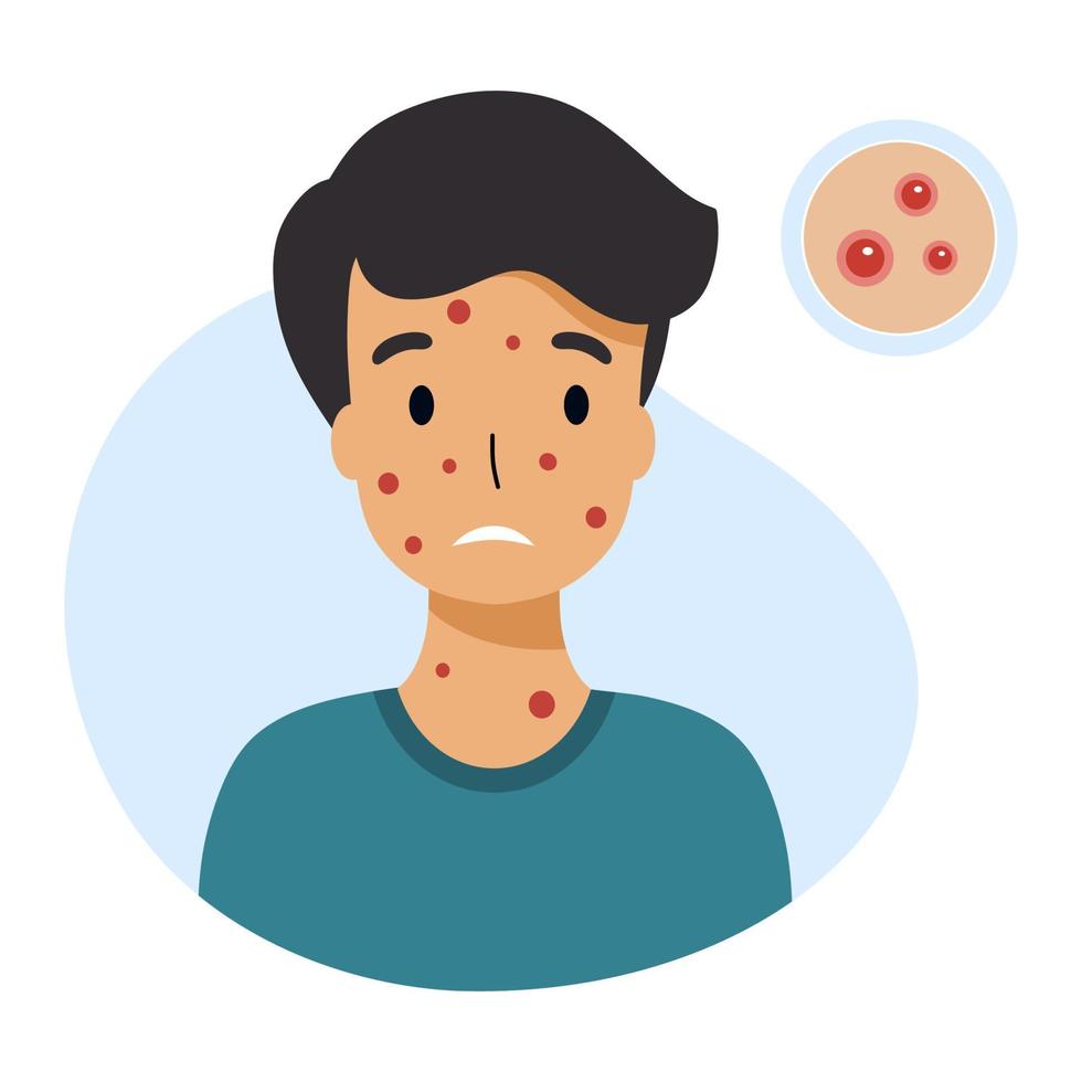 Boy with chickenpox symptoms. Skin rashes and pimples. Vector character in  flat style.