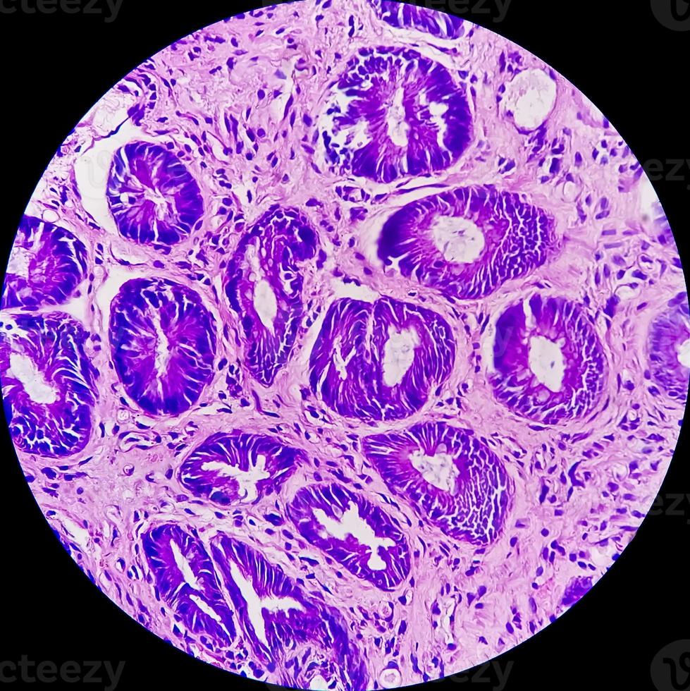 Photomicrograph of Rectal cancer. Microscopic slide view. IBD. IBS. close up. photo