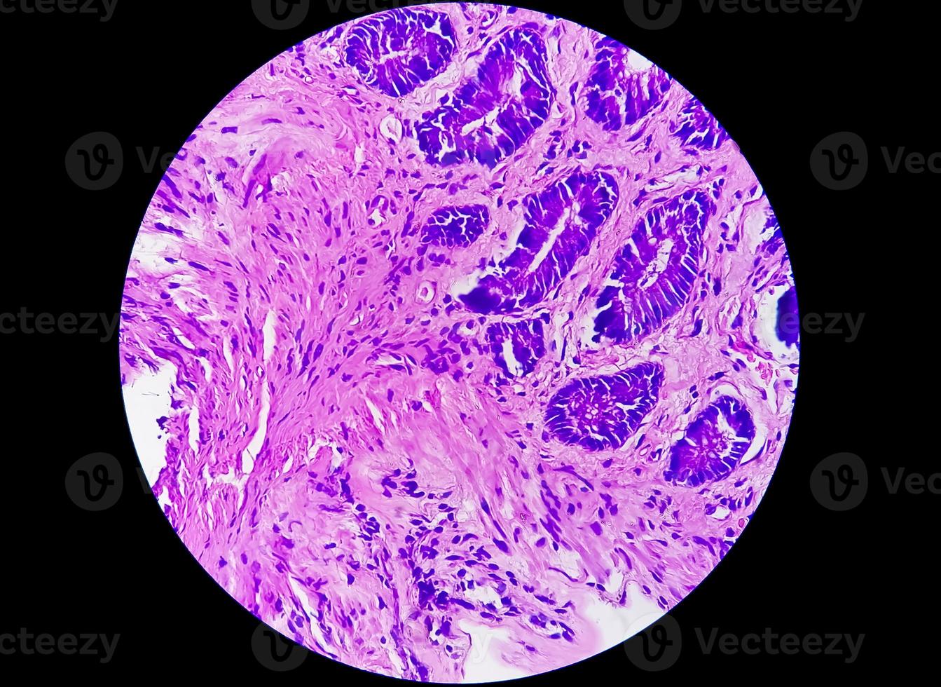 Photomicrograph of a colon biopsy obtained during colonoscopy showing Proctitis photo