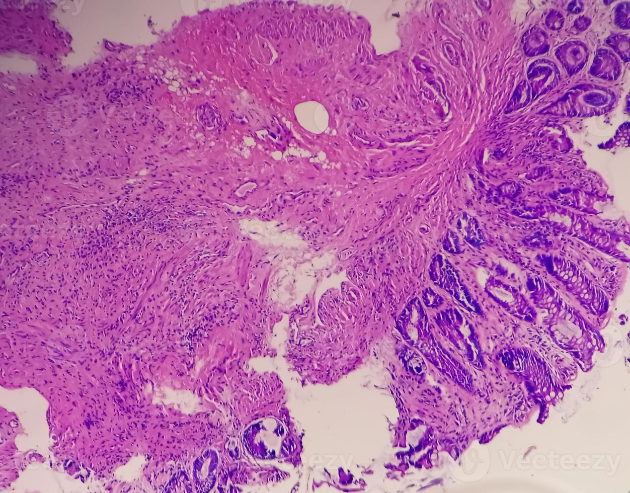 microfotografía de una biopsia de colon obtenida durante una colonoscopia que muestra proctitis foto