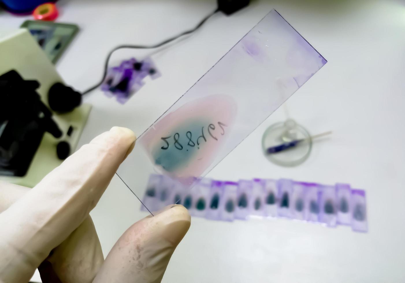 El médico sostiene un portaobjetos de vitral de frotis de sangre con tinción violeta de Leishman Giemsa en el departamento de hematología. foto