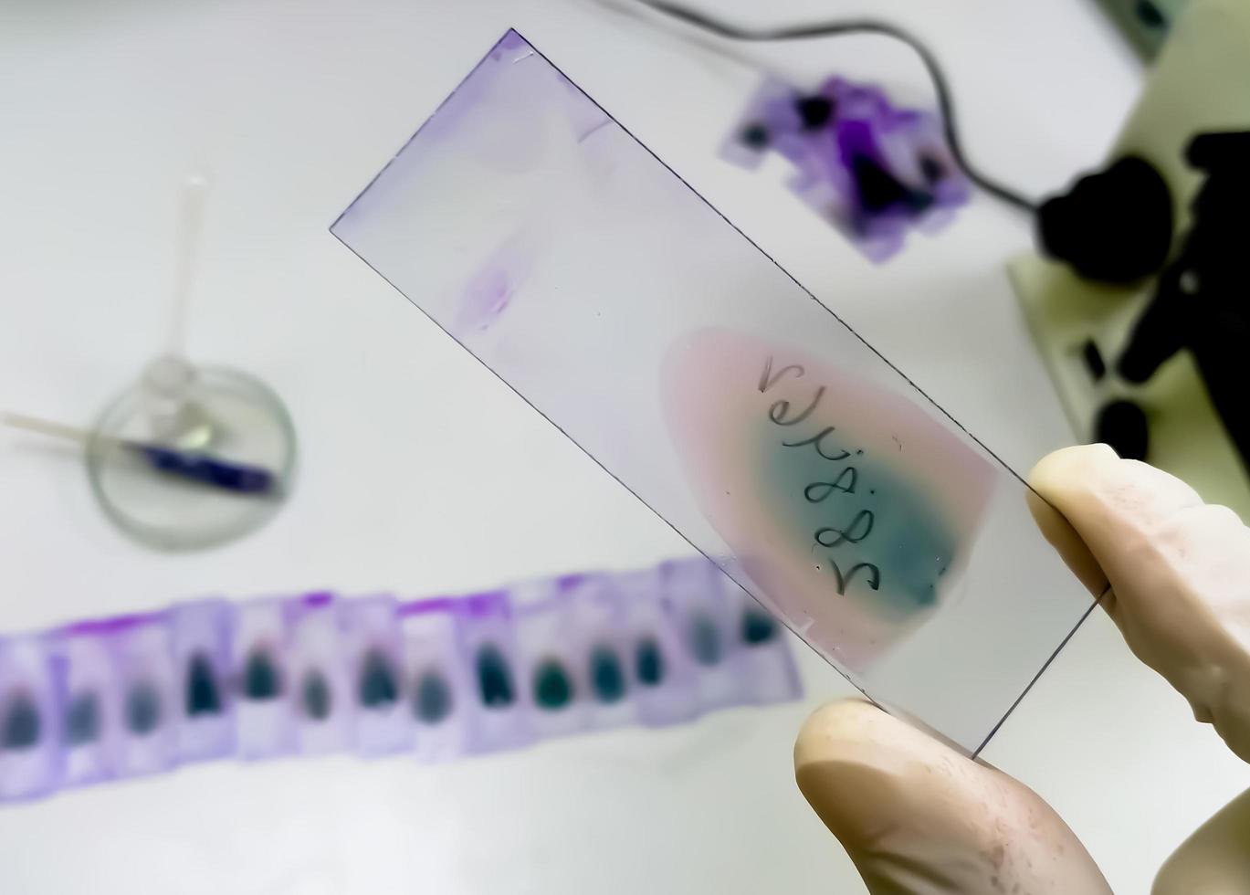 El médico sostiene un portaobjetos de vitral de frotis de sangre con tinción violeta de Leishman Giemsa en el departamento de hematología. foto