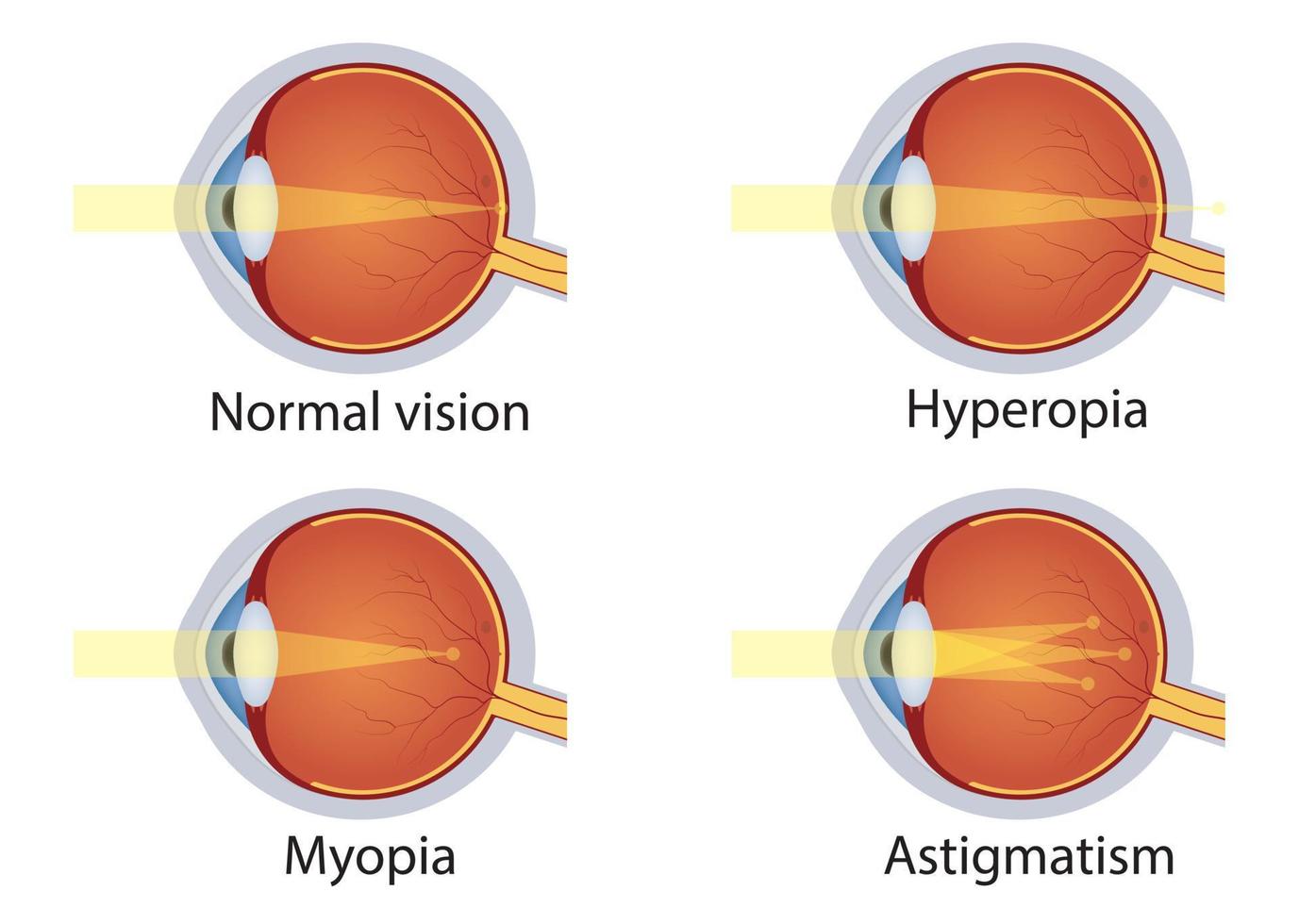 trastornos de la vista. concepto de defecto ocular. visión normal, hipermetropía, miopía, astigmatismo. globo ocular de anatomía. vector